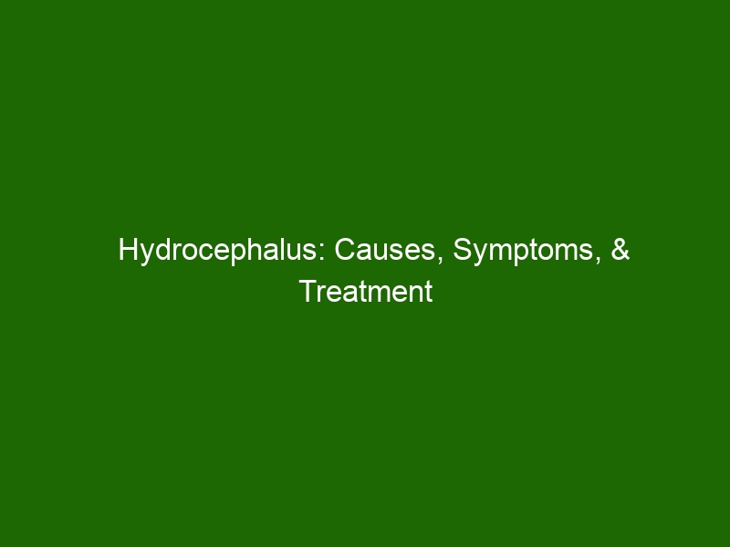 Hydrocephalus: Causes, Symptoms, & Treatment Options - Health And Beauty